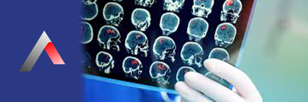  Geçici İskemik Atak